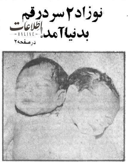 نوزاد دو سر یک ساعت زنده ماند + عکس و خبر