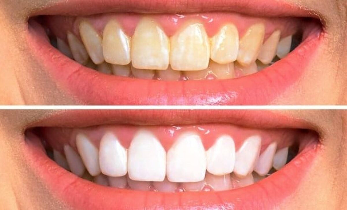 دلیل زرد شدن دندان‌ها چیست و چه راهکاری دارد؟
